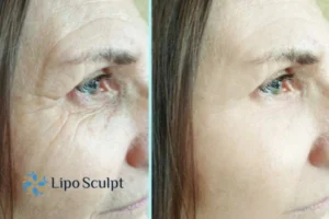 How to Fight Aging Symptoms 2 Do you want to Fight Aging Symptoms Bootle? Contact Lipo Sculpt today!