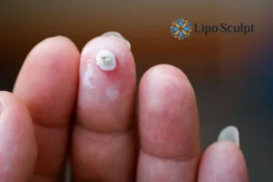 Cryopen Top 5 Treatable Conditions 4 Do you have a persistent wart of verruca that you cannot shit? Cryopen Bootle treatment will work call us NOW!