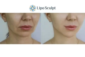 Explaining Total Skin Tightening Treatment And What It Can Do For You 2 Do you want to boost your self confidence? Give Morpheus8 Bootle a try today!