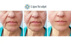 Explaining Total Skin Tightening Treatment And What It Can Do For You 3 Boost your confidence with Morpheus8 Bootle call our team today!