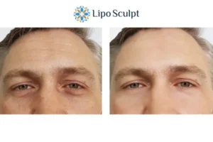 Explaining Total Skin Tightening Treatment And What It Can Do For You 6 Morpheus8 Bootle book in today to find out more!