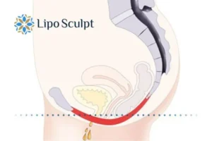 Pelvic Floor Chair Therapy 1 Pelvic Floor Chair Therapy Bootle to treat incontinence.