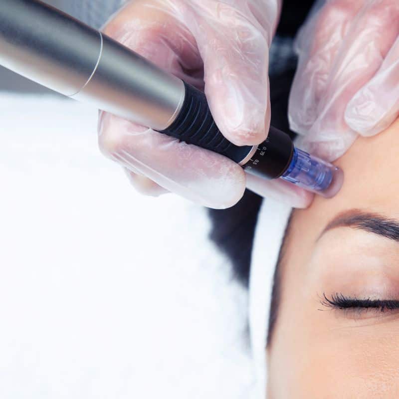 Morpheus8 treatment Bootle from Lipo Sculpt - Book in today!