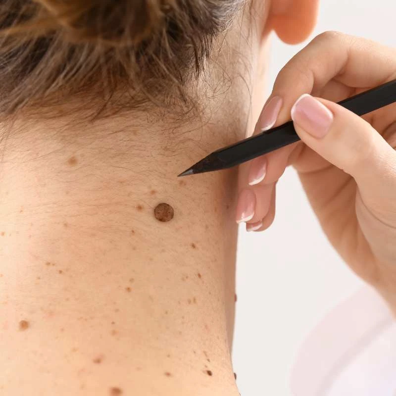 See our lesion removal prices Bootle - call today for a free quote